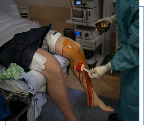 Knee replacement surgery Knee replacement surgery