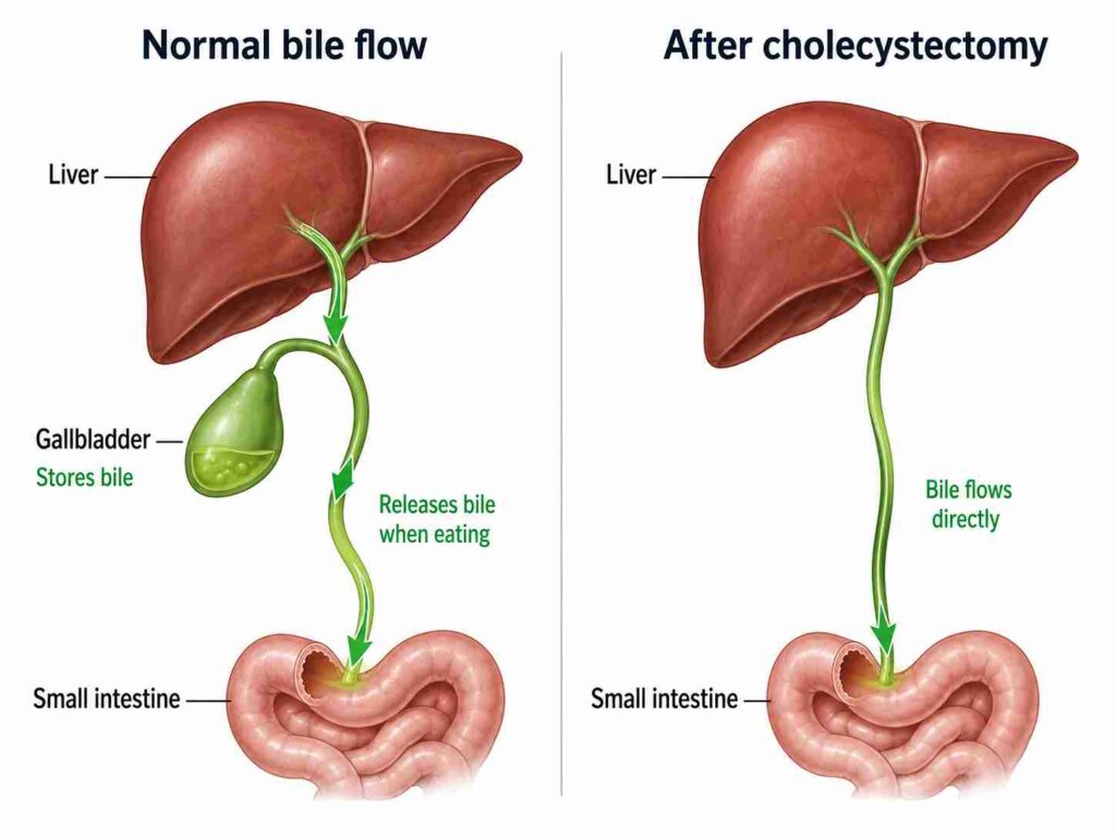Before and after diagram showing normal bile flow with gallbladder storage and bile flowing directly after gallbladder removal surgery.