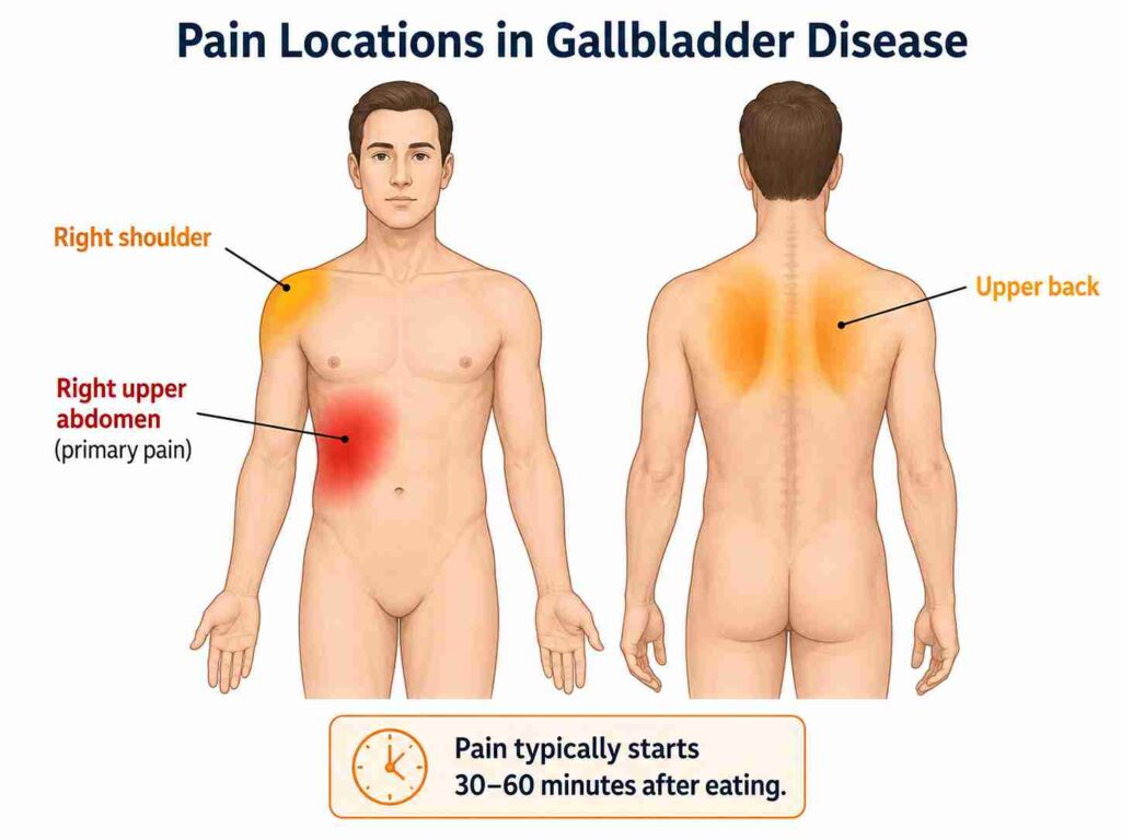 Body diagram showing gallbladder disease pain in the right upper abdomen, upper back and right shoulder after eating fatty food.